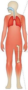 Diagram of systemic infection in the body
