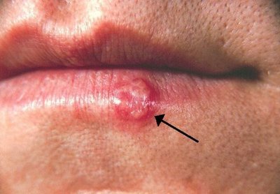 Herpes simplex lesion on lip