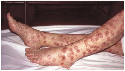 Smallpox lesions on legs