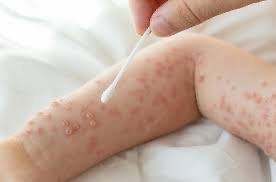 Chickenpox lesions on child