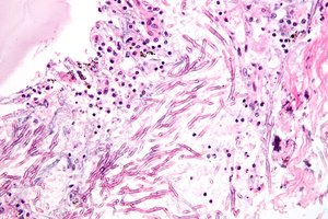 Histological section showing fungal hyphae
