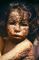 Child with smallpox, a viral disease