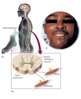 Tetanospasmin action and clinical presentation (lockjaw)