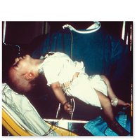 Botulinum toxin action and clinical presentation