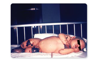 Child with meningococcemia showing widespread hemorrhagic lesions