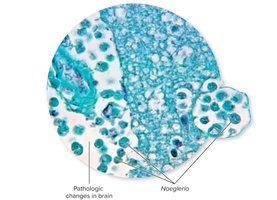 Naegleria fowleri in brain tissue