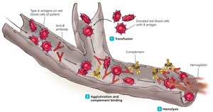 Hemolysis in transfusion reaction