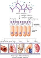 Immune complex deposition in tissues