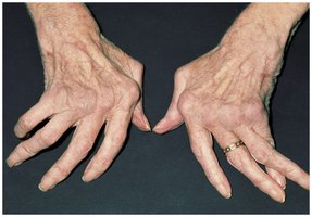 Rheumatoid arthritis in the hands