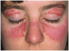 Systemic lupus erythematosus (SLE) skin manifestation