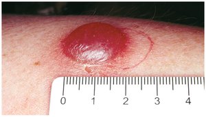 Tuberculin skin test reaction