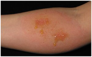 Contact dermatitis mechanism