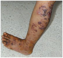 Kaposi's sarcoma on the leg