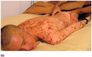 Kaposi's sarcoma on the body