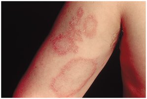 Hives (urticaria) on the skin