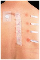 Skin test for allergy diagnosis