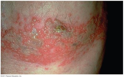 Shingles rash