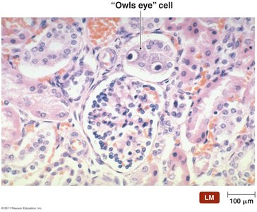 Owl's eye cell diagnostic for cytomegalovirus infection