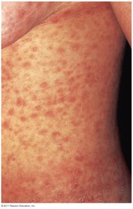 Roseola rash