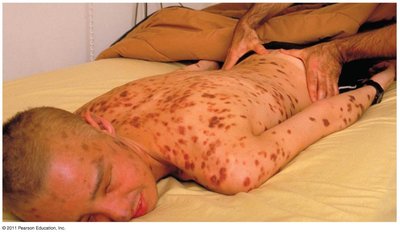 Kaposi's sarcoma lesions