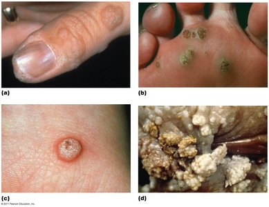 Various kinds of warts