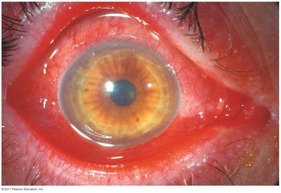 Adenoviral conjunctivitis