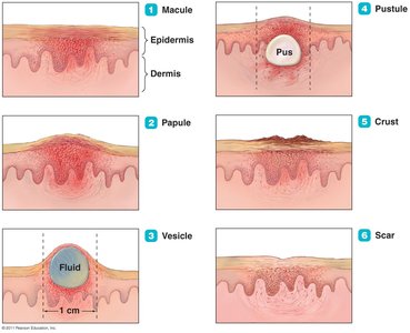 Stages of lesions in poxvirus infections