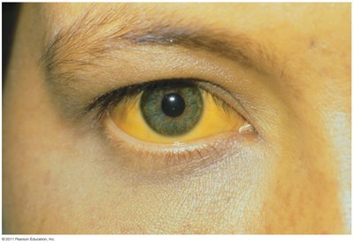 Jaundice in hepatitis B infection