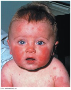 Erythema infectiosum (fifth disease)