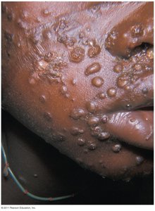 Smallpox lesions on the face