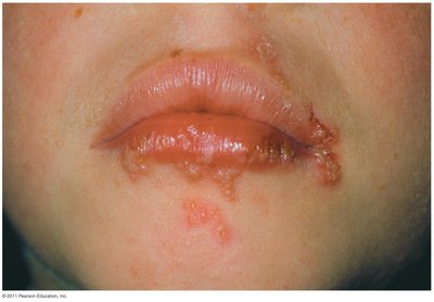 Oral herpes lesions