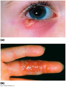 Ocular herpes and herpetic whitlow