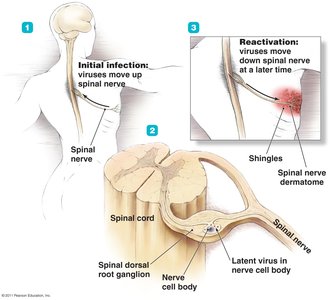 Latency and reactivation of varicella-zoster virus