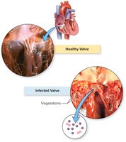 Healthy and infected heart valves with vegetations