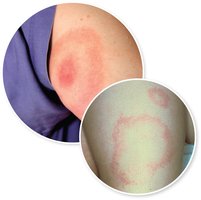 Erythema migrans rash of Lyme disease