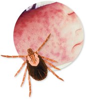 Tick and RMSF rash