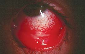 Severe conjunctival infection