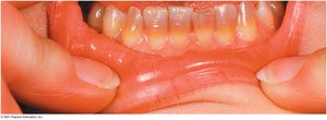 Staining of teeth from tetracycline use