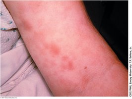 Hives due to immediate hypersensitivity