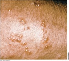 Blisters from delayed-type hypersensitivity
