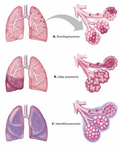 Types of pneumonia: bronchopneumonia, lobar pneumonia, interstitial pneumonia