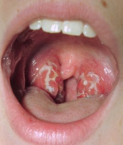 Streptococcal pharyngitis with whitish exudate