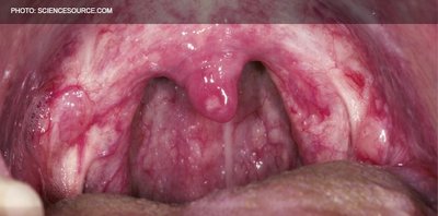 Scarlet fever throat appearance