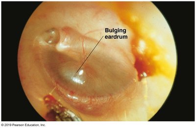 Bulging eardrum in otitis media