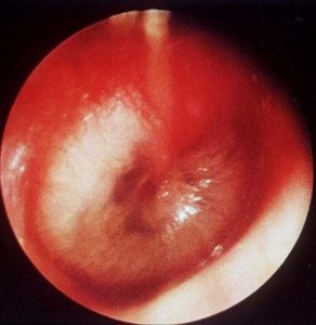 Inflamed eardrum in otitis media