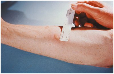 Tuberculin skin test (Mantoux test)