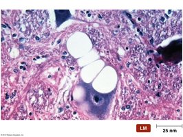 Vacuole formation in prion disease