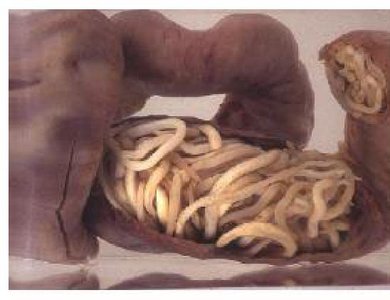 Ascaris lumbricoides in intestine
