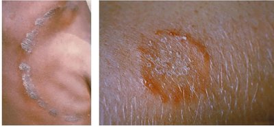 Ringworm infection on skin