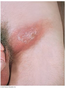 Bubo in lymphogranuloma venereum (LGV)